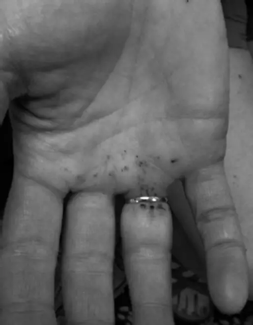 sea urchin sting on a hand